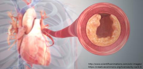 Cardiovascular disease